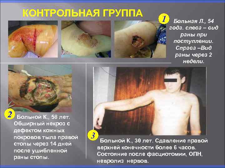 КОНТРОЛЬНАЯ ГРУППА 2 Больной К. , 58 лет. Обширный некроз с дефектом кожных покровов