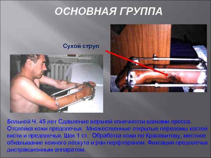 ОСНОВНАЯ ГРУППА Сухой струп Больной Ч. 45 лет Сдавление верхней конечности вaлками пресса. Отслойка