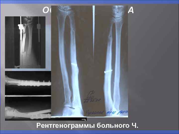 ОСНОВНАЯ ГРУППА Рентгенограммы больного Ч. 
