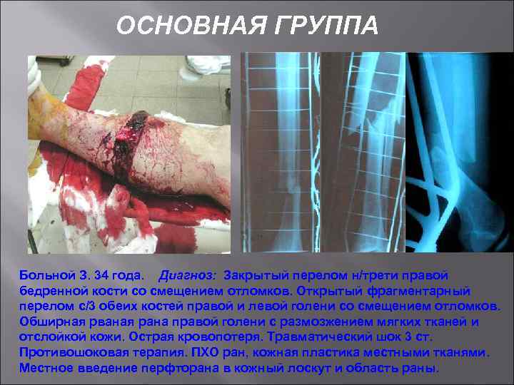 ОСНОВНАЯ ГРУППА Больной З. 34 года. Диагноз: Закрытый перелом н/трети правой бедренной кости со