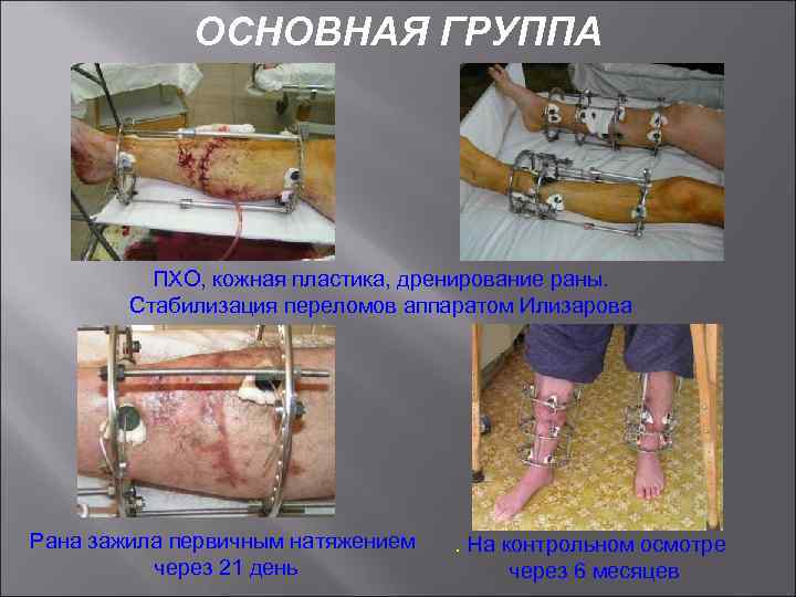ОСНОВНАЯ ГРУППА ПХО, кожная пластика, дренирование раны. Стабилизация переломов аппаратом Илизарова Рана зажила первичным