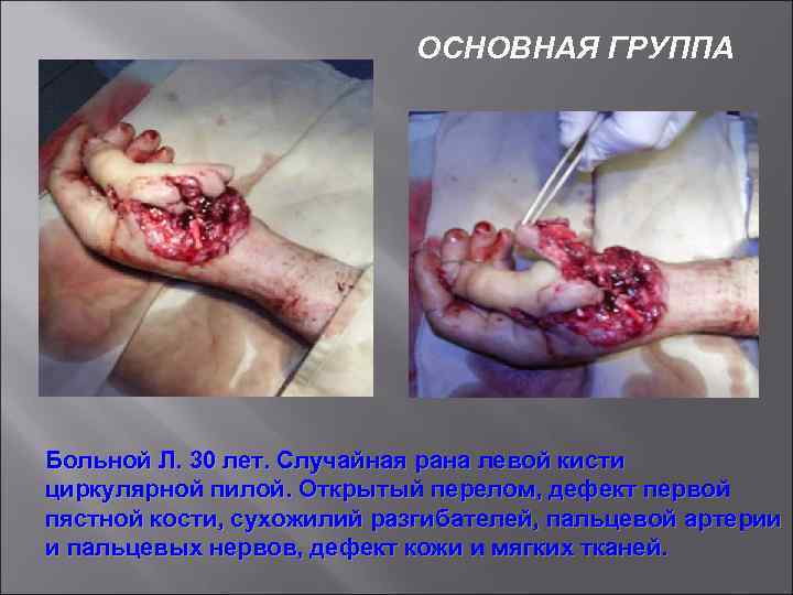 ОСНОВНАЯ ГРУППА Больной Л. 30 лет. Случайная рана левой кисти циркулярной пилой. Открытый перелом,