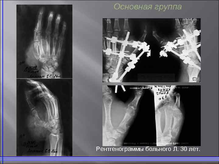 Основная группа Рентгенограммы больного Л. 30 лет. 