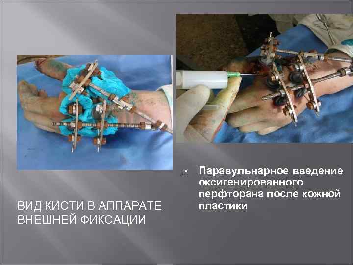  ВИД КИСТИ В АППАРАТЕ ВНЕШНЕЙ ФИКСАЦИИ Паравульнарное введение оксигенированного перфторана после кожной пластики