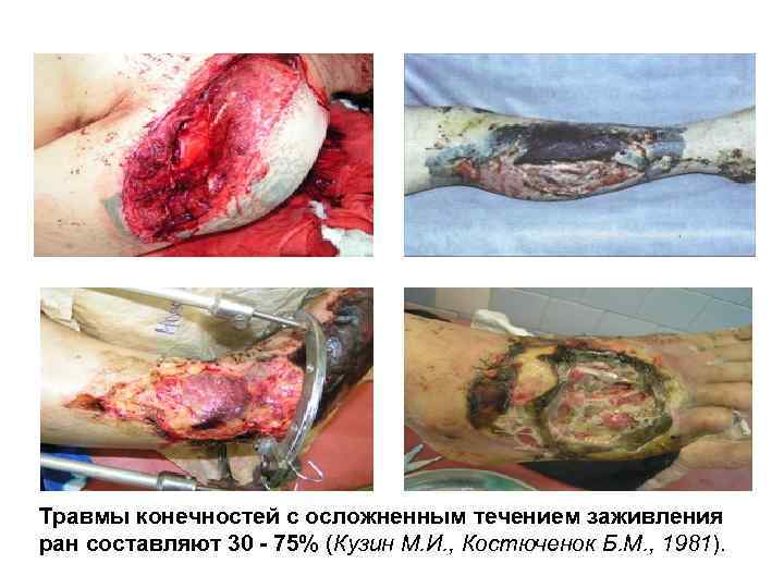 Травмы конечностей с осложненным течением заживления ран составляют 30 - 75% (Кузин М. И.