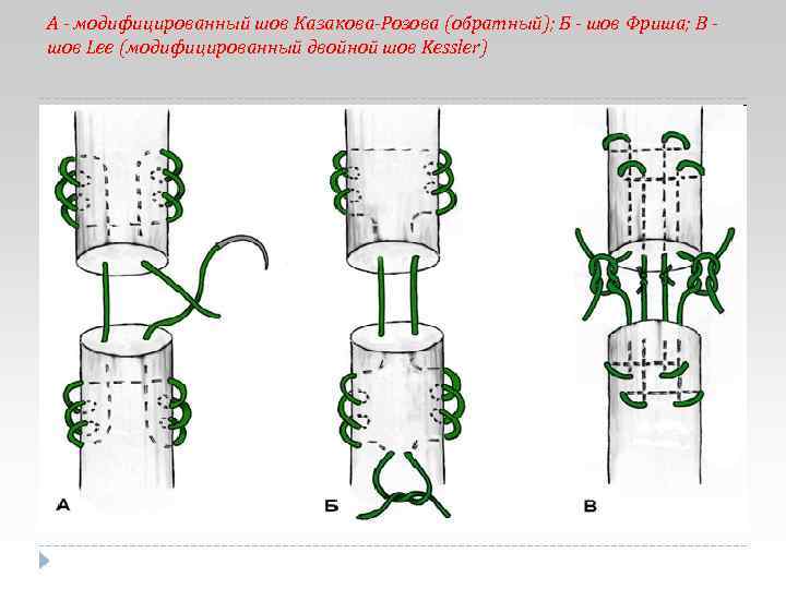 Обратный б. Шов Казакова сухожильный. Сухожильный шов по Казакову розову. Сухожильный шов Казакова-Розова. Сухожильный шов Казакова техника.