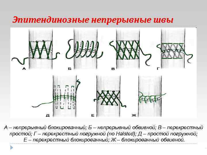 Шов мультановского схема