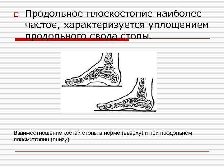 o Продольное плоскостопие наиболее частое, характеризуется уплощением продольного свода стопы. Взаимоотношение костей стопы в
