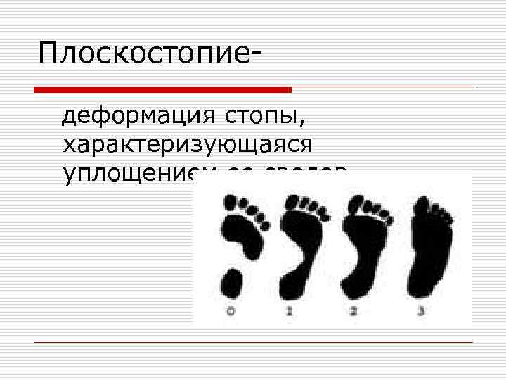 Выявление плоскостопия лабораторная работа 8 класс. Плоскостопие деформация стопы характеризующаяся уплощением. Классификация плоскостопия по степеням. Классификация обуви плоскостопие. Вывод на тему плоскостопие.