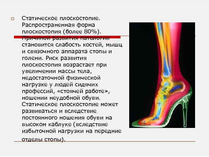 o Статическое плоскостопие. Распространенная форма плоскостопия (более 80%). Причиной развития патологии становится слабость костей,