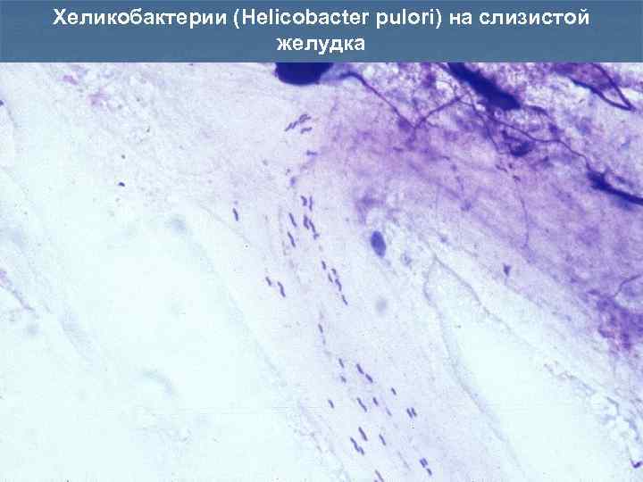 Хеликобактерии (Helicobacter pulori) на слизистой желудка 16 