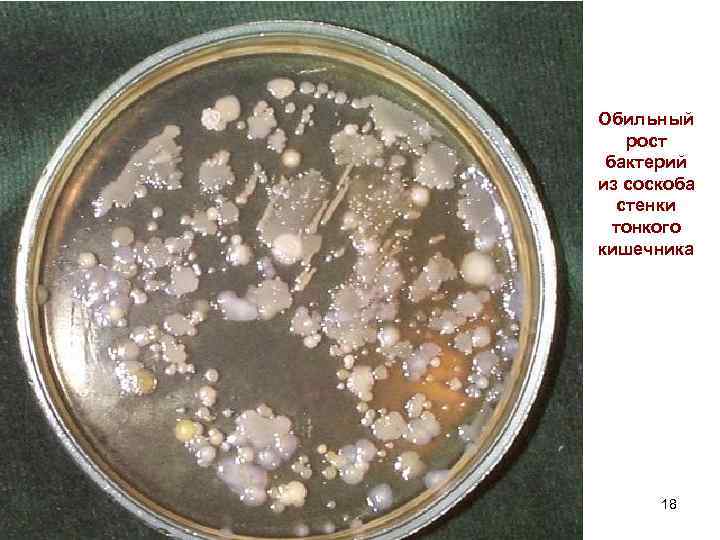 Обильный рост бактерий из соскоба стенки тонкого кишечника 18 