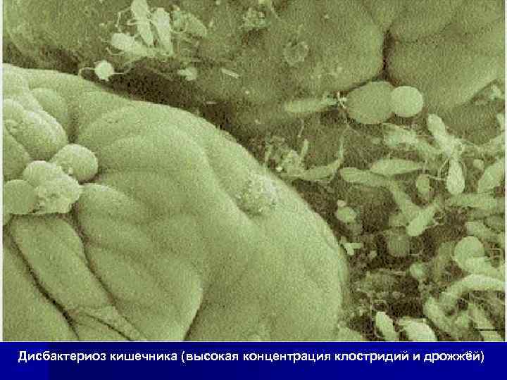 42 Дисбактериоз кишечника (высокая концентрация клостридий и дрожжей) 