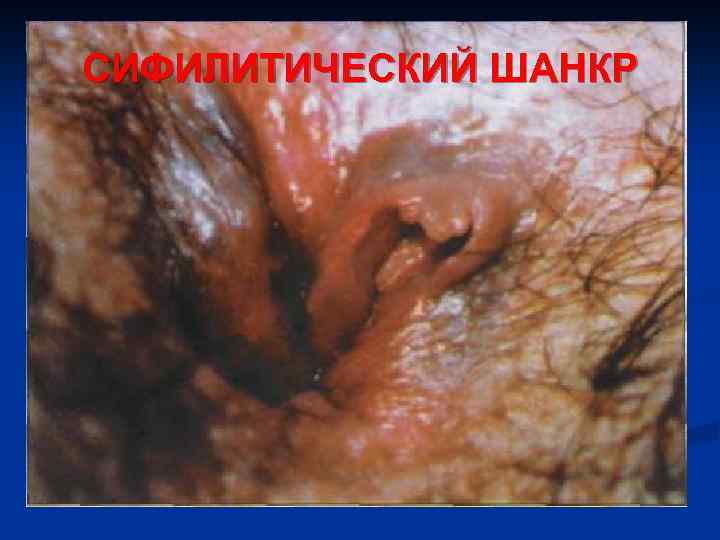 СИФИЛИТИЧЕСКИЙ ШАНКР 