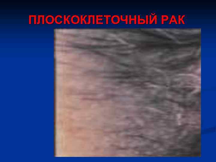 ПЛОСКОКЛЕТОЧНЫЙ РАК 