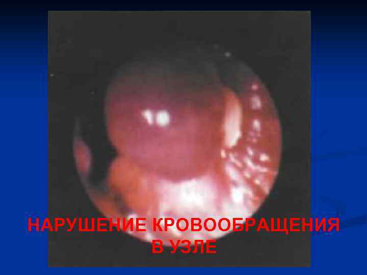 НАРУШЕНИЕ КРОВООБРАЩЕНИЯ В УЗЛЕ 
