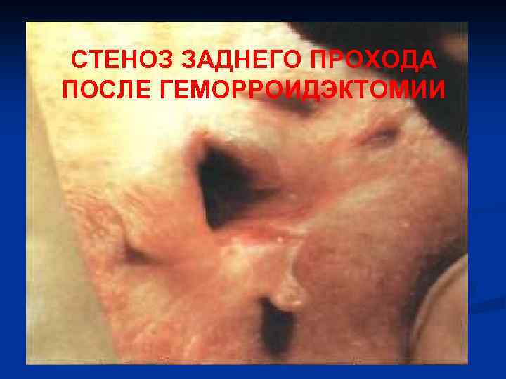 СТЕНОЗ ЗАДНЕГО ПРОХОДА ПОСЛЕ ГЕМОРРОИДЭКТОМИИ 
