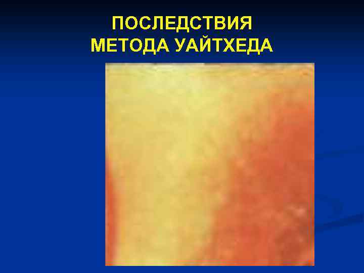 ПОСЛЕДСТВИЯ МЕТОДА УАЙТХЕДА 