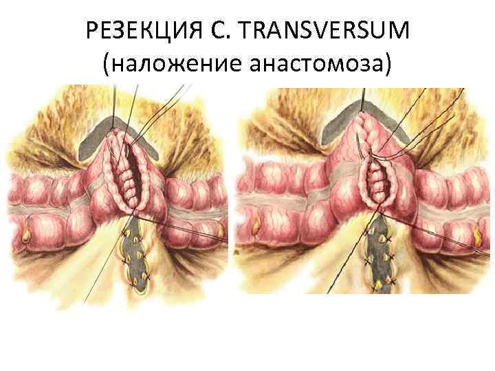 РЕЗЕКЦИЯ C. TRANSVERSUM (наложение анастомоза) 
