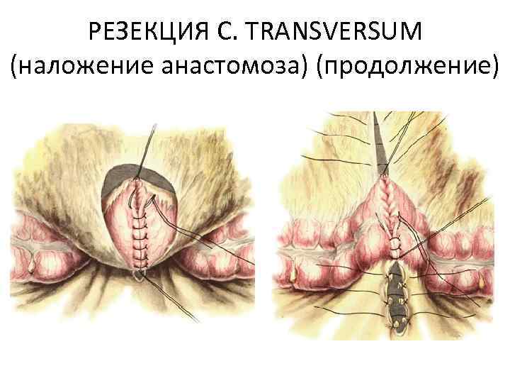 РЕЗЕКЦИЯ C. TRANSVERSUM (наложение анастомоза) (продолжение) 