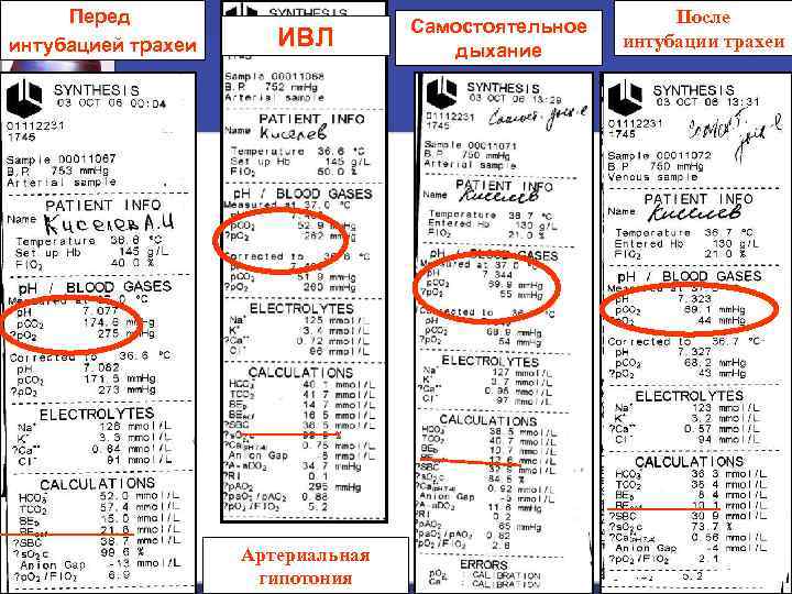 Перед интубацией трахеи ИВЛ Артериальная гипотония Самостоятельное дыхание После интубации трахеи 