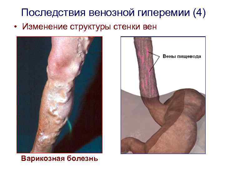 Последствия венозной гиперемии (4) • Изменение структуры стенки вен Варикозная болезнь 