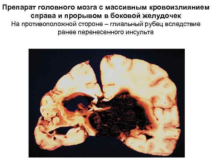 Препарат головного мозга с массивным кровоизлиянием справа и прорывом в боковой желудочек На противоположной