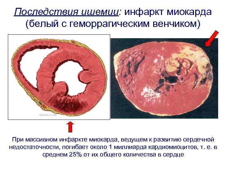 Последствия ишемии: инфаркт миокарда (белый с геморрагическим венчиком) При массивном инфаркте миокарда, ведущем к