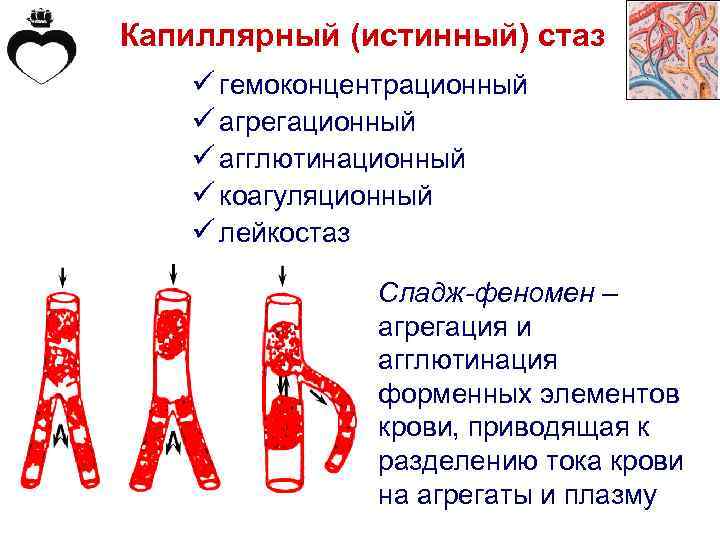 Капиллярный (истинный) стаз ü гемоконцентрационный ü агрегационный ü агглютинационный ü коагуляционный ü лейкостаз Сладж-феномен