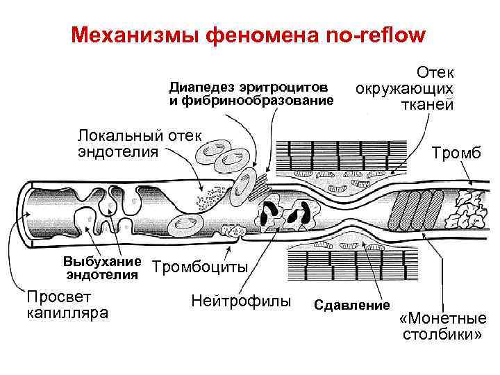 Механизмы феномена no-reflow Диапедез эритроцитов и фибринообразование Отек окружающих тканей Локальный отек эндотелия Выбухание