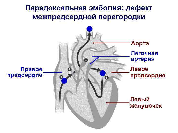 Парадоксальная эмболия: дефект межпредсердной перегородки Аорта Легочная артерия Правое предсердие Левый желудочек 