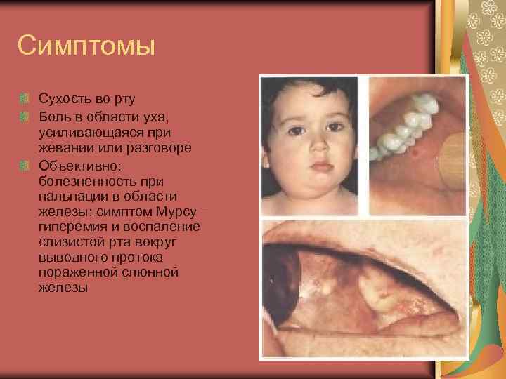 Симптомы Сухость во рту Боль в области уха, усиливающаяся при жевании или разговоре Объективно: