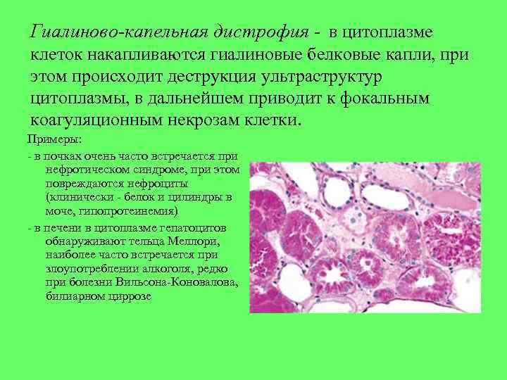 Гиалиново-капельная дистрофия - в цитоплазме клеток накапливаются гиалиновые белковые капли, при этом происходит деструкция