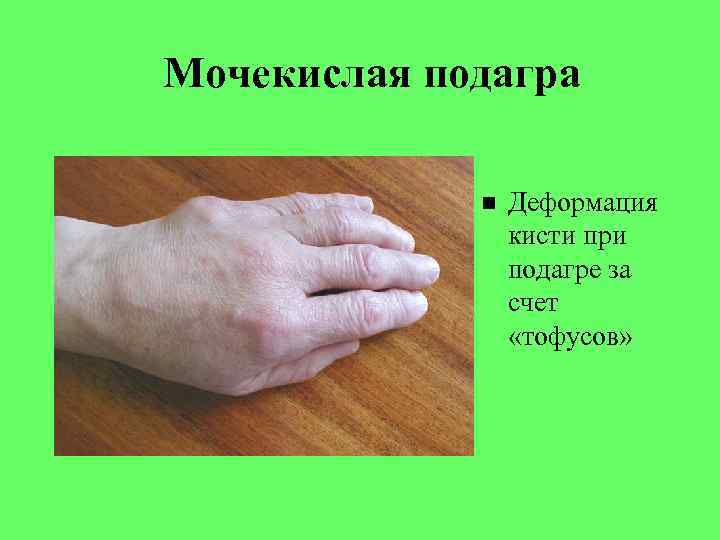 Мочекислая подагра Деформация кисти при подагре за счет «тофусов» 