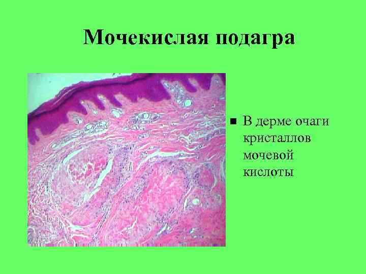 Мочекислая подагра В дерме очаги кристаллов мочевой кислоты 
