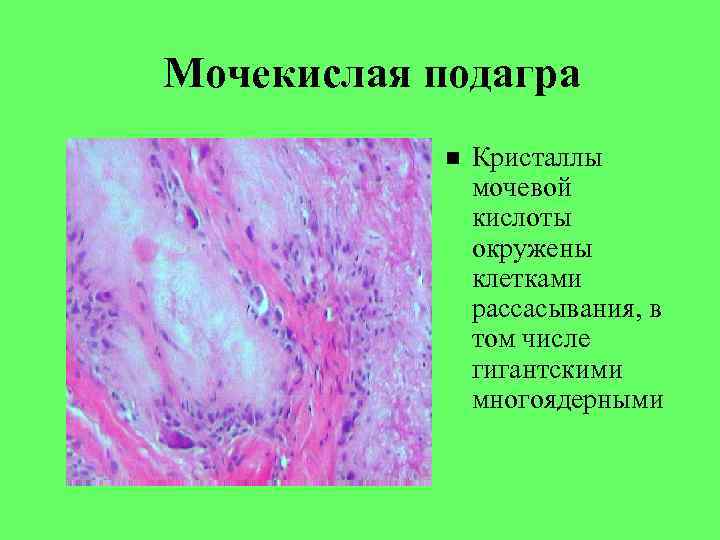 Мочекислая подагра Кристаллы мочевой кислоты окружены клетками рассасывания, в том числе гигантскими многоядерными 