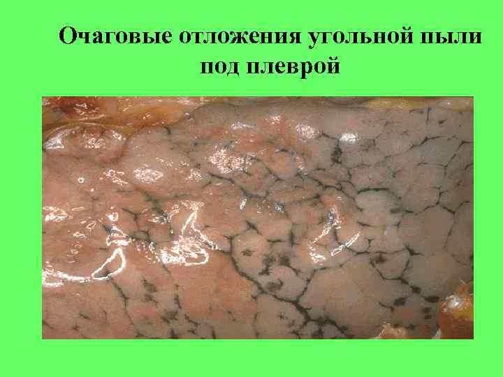 Очаговые отложения угольной пыли под плеврой 