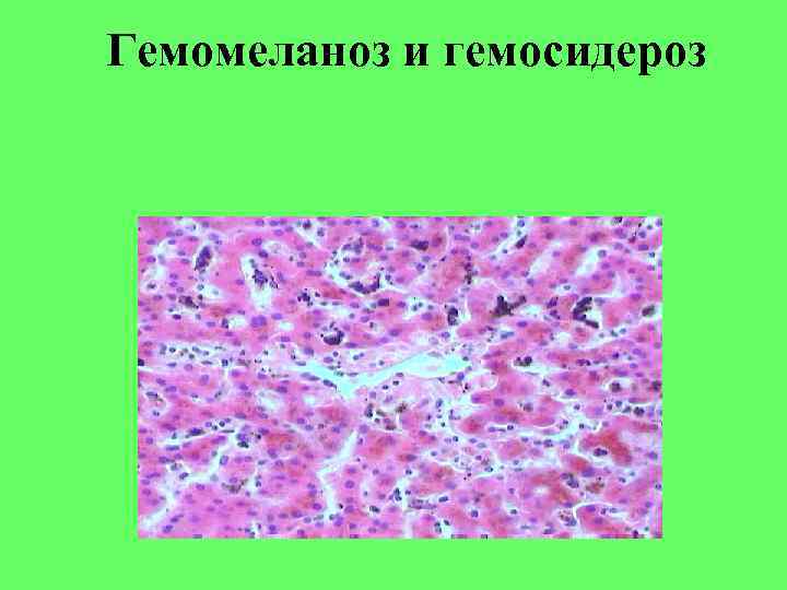 Гемомеланоз и гемосидероз 