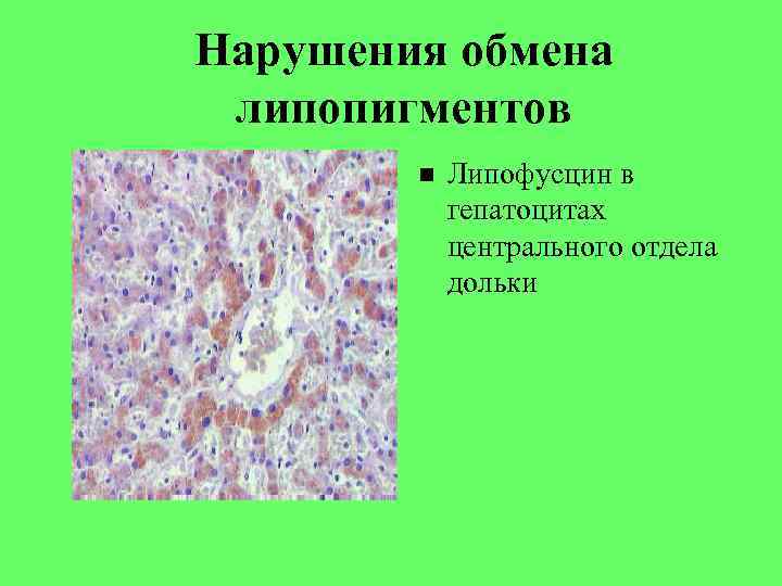 Нарушения обмена липопигментов Липофусцин в гепатоцитах центрального отдела дольки 