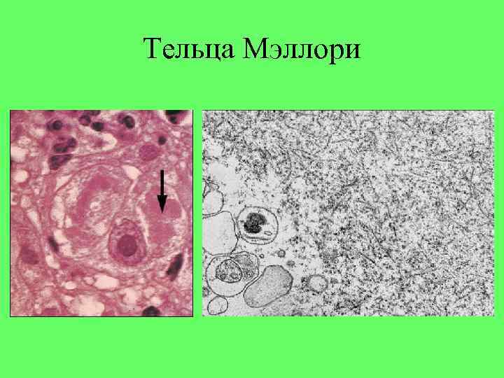 Тельца Мэллори 