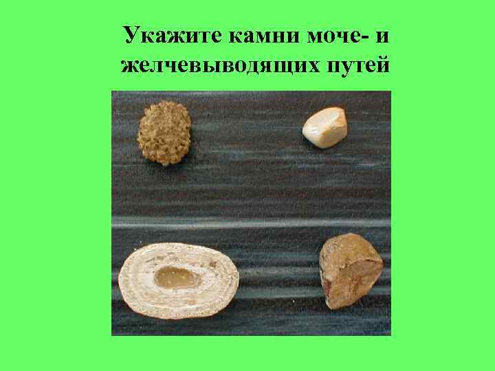 Укажите камни моче- и желчевыводящих путей 