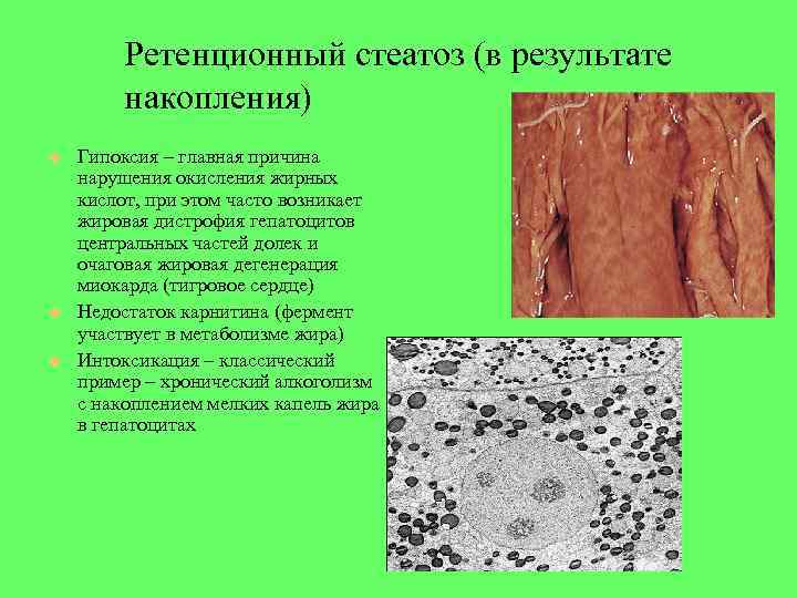 Ретенционный стеатоз (в результате накопления) Гипоксия – главная причина нарушения окисления жирных кислот, при
