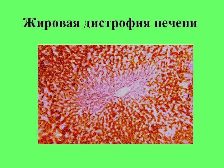 Жировая дистрофия печени 