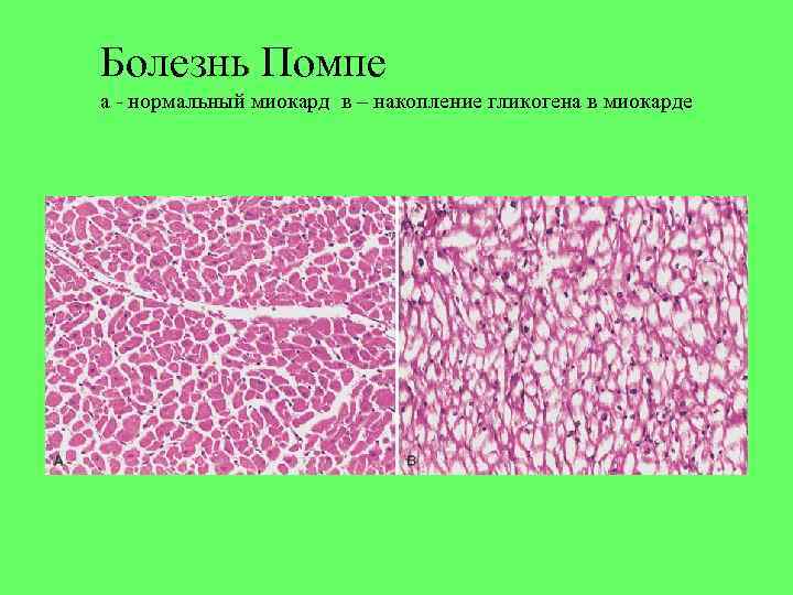 Болезнь Помпе а - нормальный миокард в – накопление гликогена в миокарде 