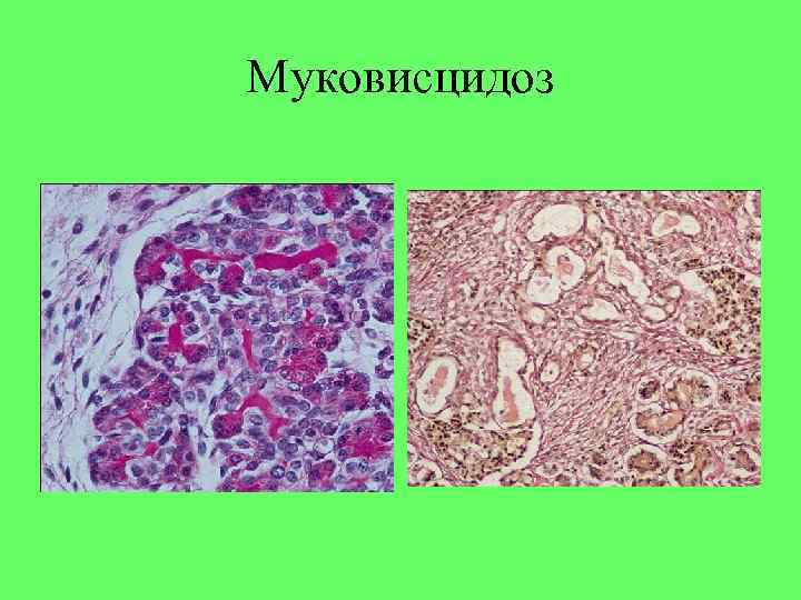 Муковисцидоз 