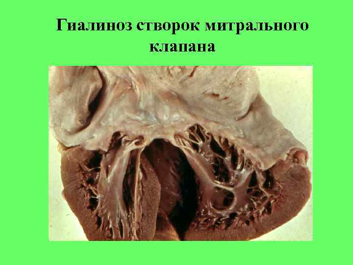 Гиалиноз створок митрального клапана 