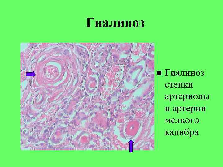 Гиалиноз стенки артериолы и артерии мелкого калибра 