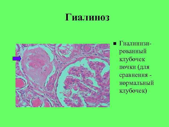 Гиалиноз Гиалинизированный клубочек почки (для сравнения нормальный клубочек) 
