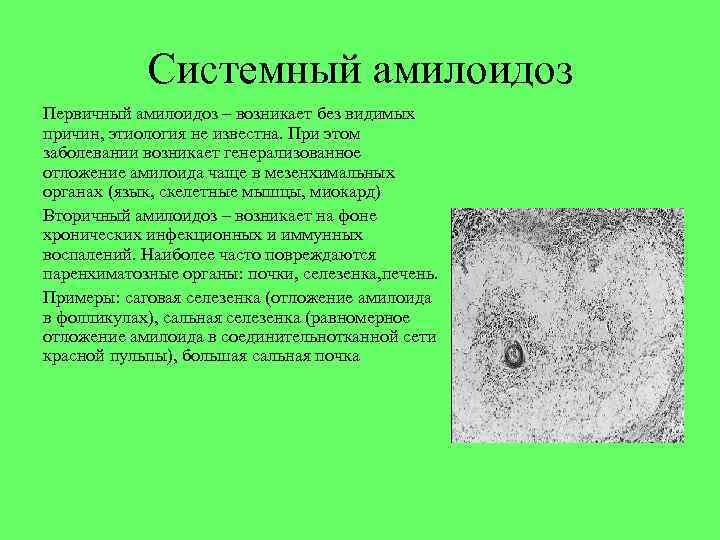 Системный амилоидоз Первичный амилоидоз – возникает без видимых причин, этиология не известна. При этом