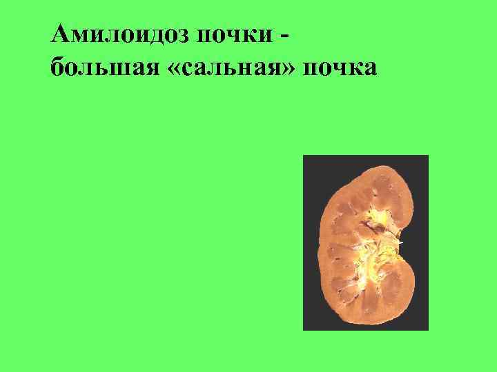 Амилоидоз почки большая «сальная» почка 